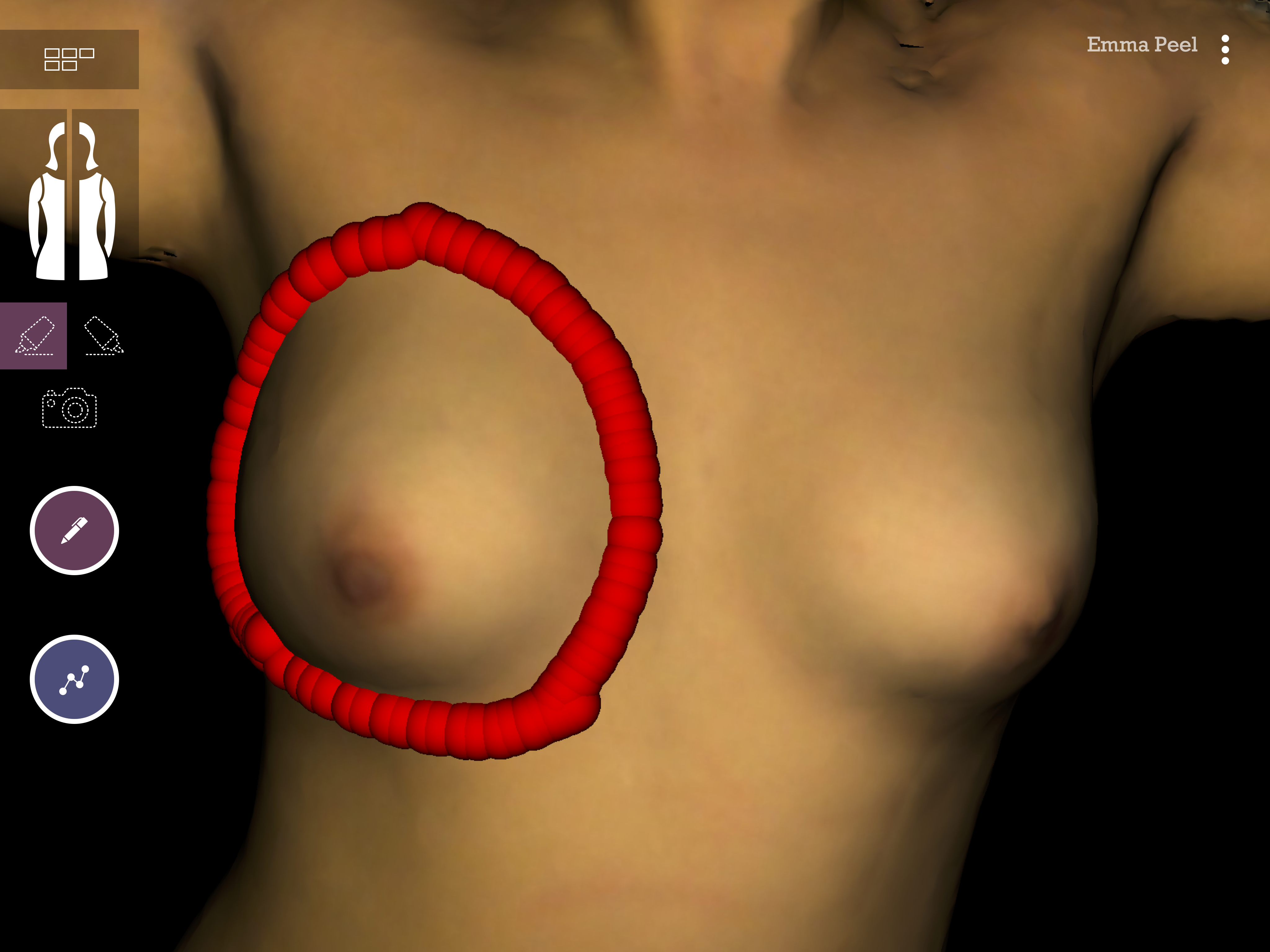 Surgery Trace on 3D model