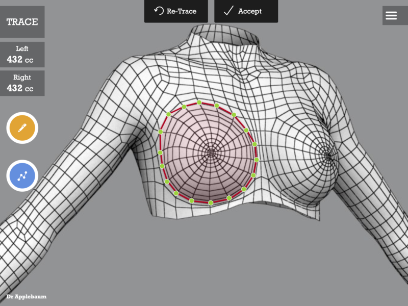 Surgery Trace on Body Scan Wireframe